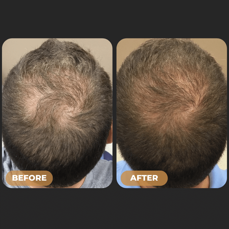 SPARTAN™ - Full Hair Growth System