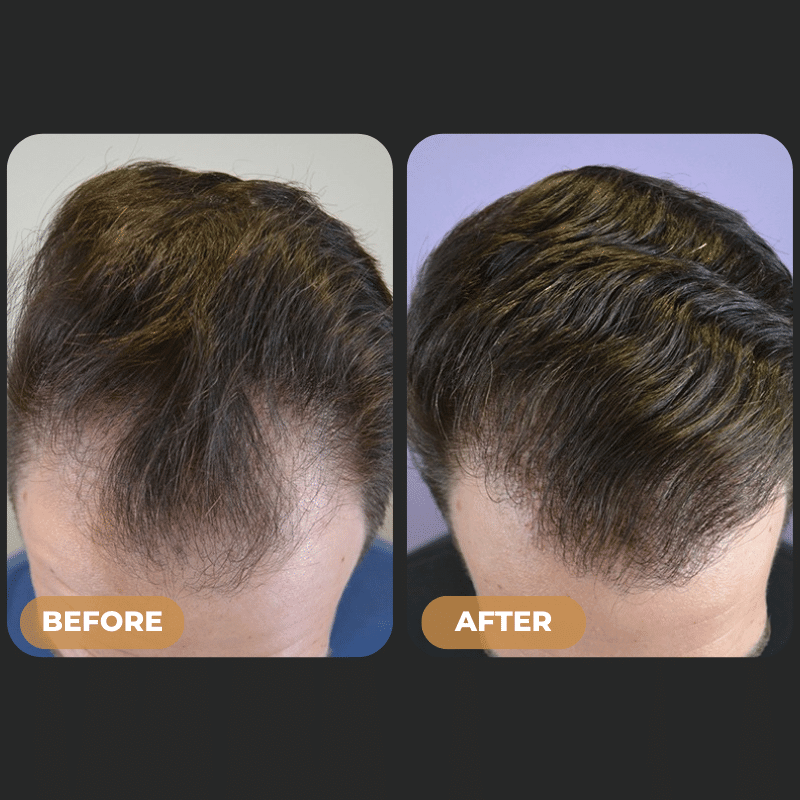 SPARTAN™ - Full Hair Growth System