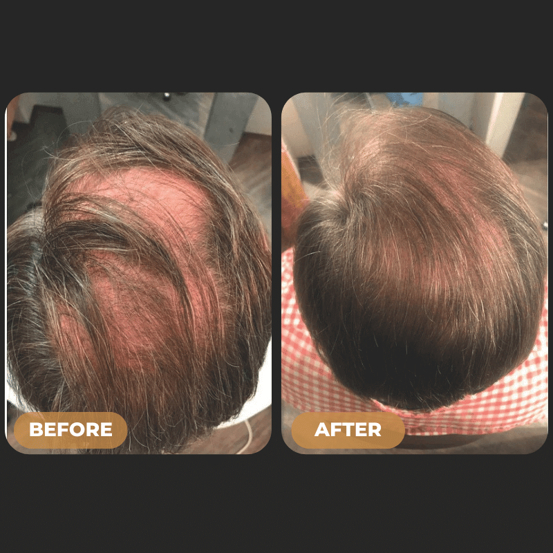 SPARTAN™ - Full Hair Growth System